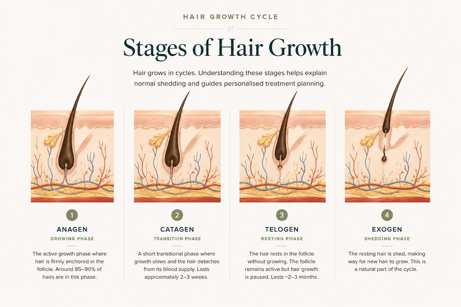Editorial medical illustration showing the four stages of the hair growth cycle: anagen (growing), catagen (transition), telogen (resting) and exogen (shedding).